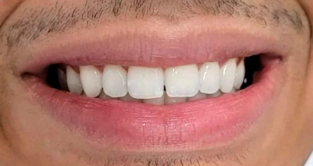 Sorriso depois do tratamento
