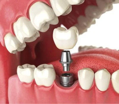 Ilustração: implante dentário